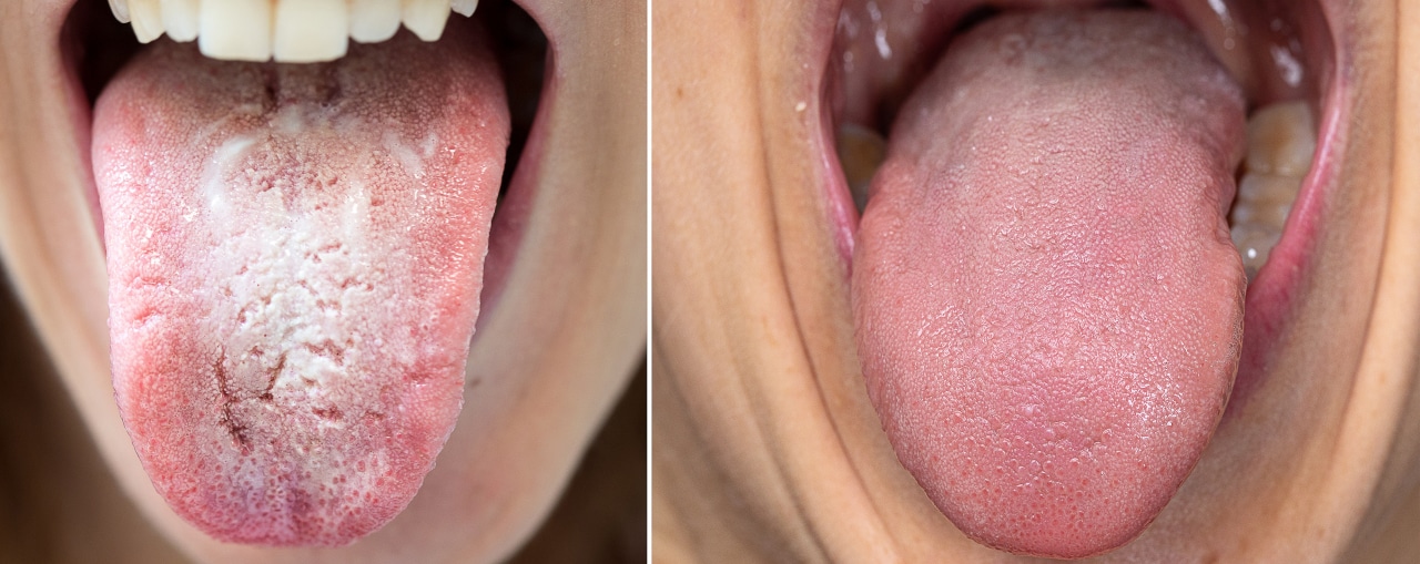 Mundsoor Bilder Soor im Mund auf Zunge vs gesunde Zunge