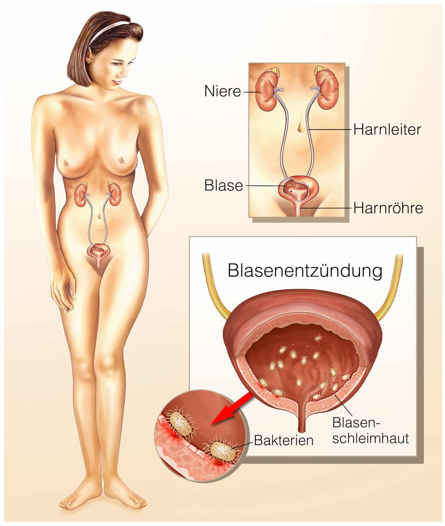 Blasenentzündung - Schema