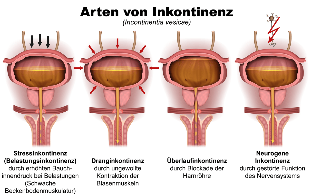 Formen - Arten der Inkontinenz