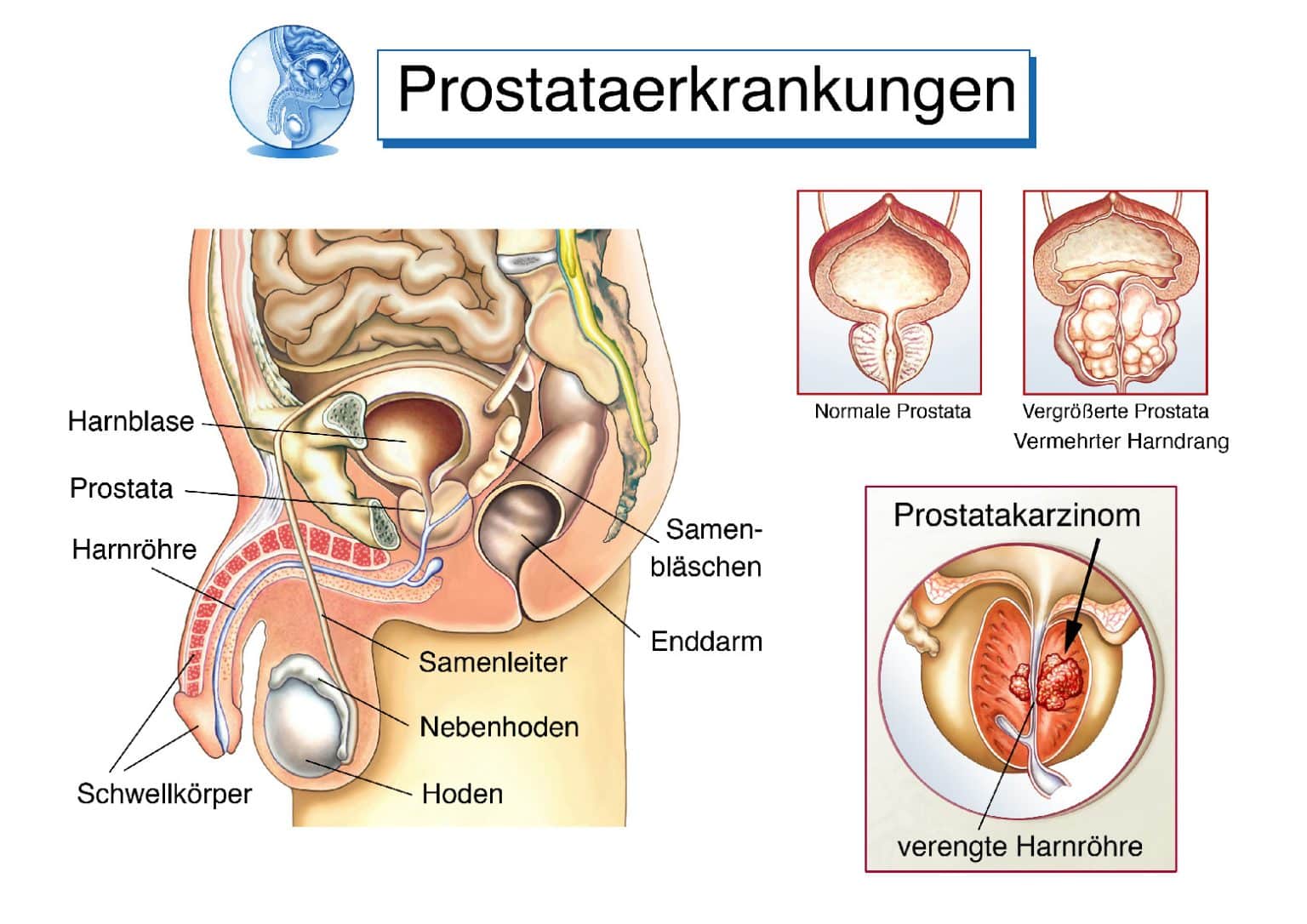 Prostata Untersuchung mögliche Krankheiten